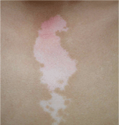 白癜风的发病部位及特点