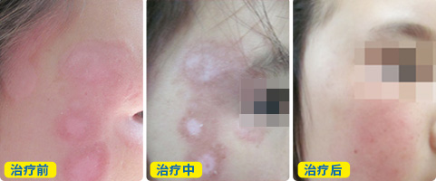 脸上长了白癜风好治吗 要多长时间才能恢复