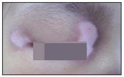 儿童眼角处皮肤有块白斑是什么