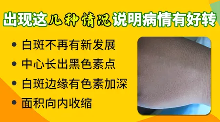 无花果叶子泡酒涂白斑有用吗
