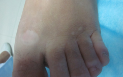 手脚光滑的白斑是什么 长白斑的原因有哪些