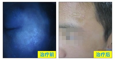 伍德灯面部白癜风的照片