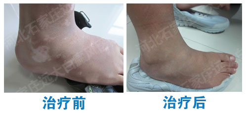 白癜风治疗一次费用要多少钱