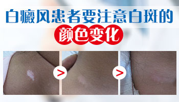 白癜风淡白色和瓷白色有啥区别