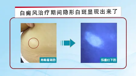白癜风一边照光一边长新的白斑正常吗