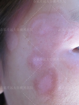 白斑变粉色是好转吗