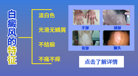 如何鉴别孩子白癜风