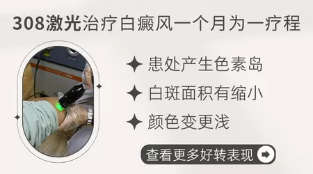 白癜风光疗总疗程需要多少次 效果何时显现