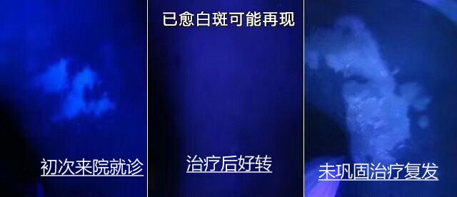 普通白斑和白癜风在伍德灯下图片