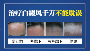 为什么你的白癜风迟迟不去医治