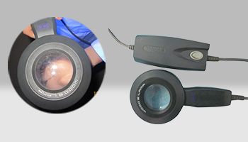 白癜风早期症状图片 早期白斑诊断与治疗