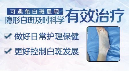 伍德灯下白斑面积比肉眼看到的大是不是要扩散