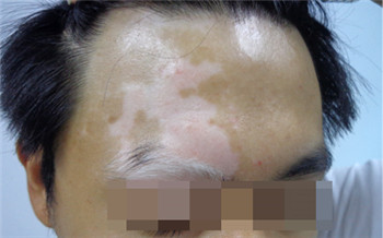 脸上的白斑有一年多了还能治好吗