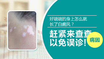 儿童白癜风初期图片是啥样