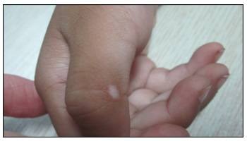 新生儿白癜风图片 小孩为什么会长斑