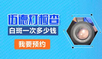 伍德灯照一次多少钱 检查白斑准确吗