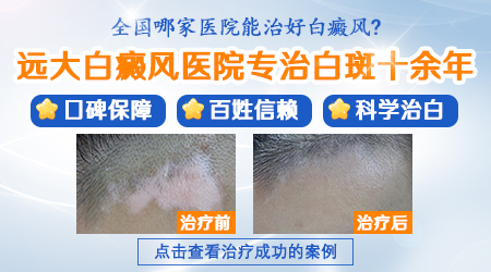 中医治疗白癜风的药方