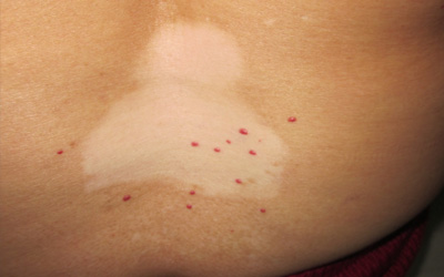 腰部白斑是白癜风的概率大不大