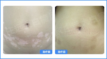 男性耳朵周围白癜风治疗过效果不明显