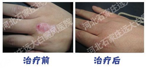 手掌的白癜风可以根治