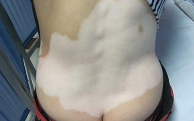 石家庄远大白癜风医院收费贵不贵