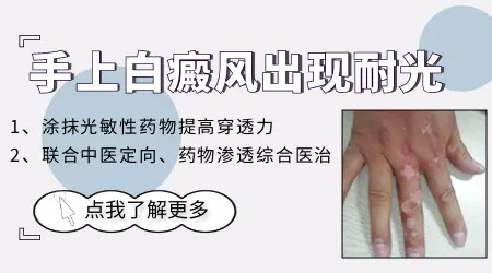 白癜风照308激光产生耐光性怎么办
