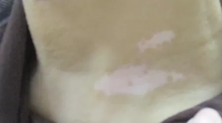 脖子上长白点用什么药膏