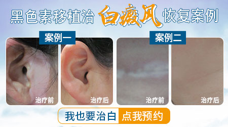 白癜风皮肤移植后的样子和正常皮肤有差距吗