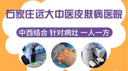 石家庄远大中医皮肤病医院治白癜风效果好吗