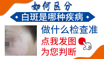 小孩脸上有一块肤色不均匀发白是白癜风吗