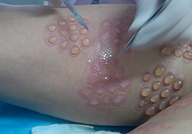 白癜风植皮后皮肤样子图片