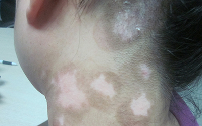 太阳晒伤脖子出现白斑如何辨别是什么病