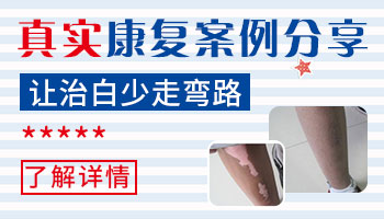 儿童白癜风治好的案例
