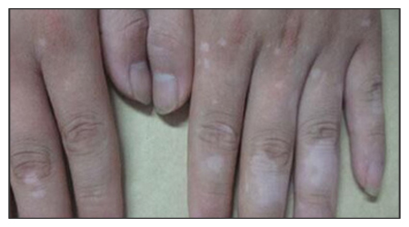 手上白斑的早期图片 手指白斑图片