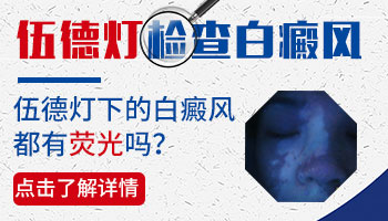 用伍德灯检查有荧光一定是白癜风吗