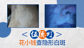 隐形白斑吃药能控制住吗