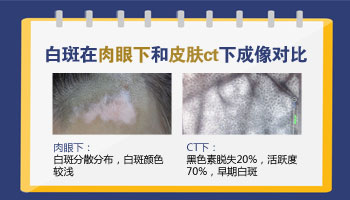 白癜风皮肤CT的表现是什么