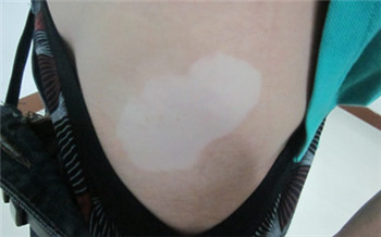 宝宝身上长一块白的是什么