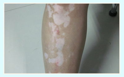 女性腿部的皮肤白斑患者的图片