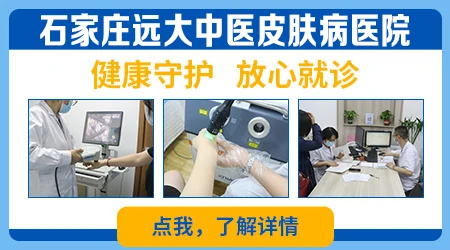 石家庄治疗白癜风哪家好