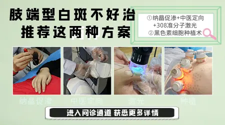 手背上的白斑照激光管用吗