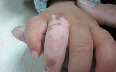 儿童手指长白斑的图片