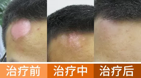吃中药治疗白癜风的真实案例