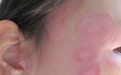 初期脸上白癜风的图片