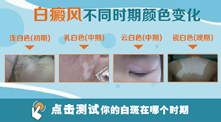 擦药能不能治好白癜风