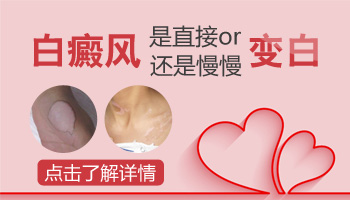 白癜风是突然变白还是慢慢变白