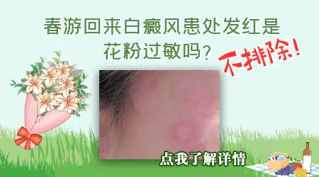 去完植物园白癜风发红是花粉过敏吗