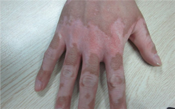 手背上长白点图片 白点不痛不痒是怎么了