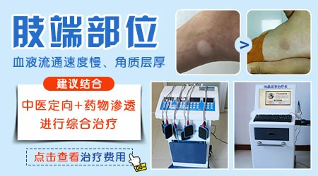 肢端型白癜风会不会扩散到面部