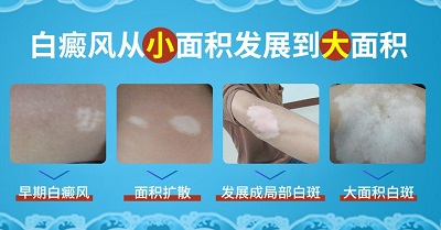 怀孕后白癜风发展的厉害